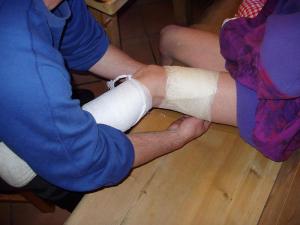 Popálenina 2. stupně, foto: Hanka T.