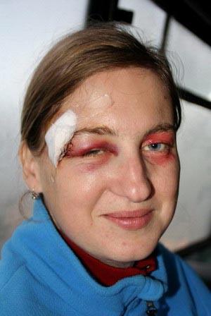 Zraněná reportérka