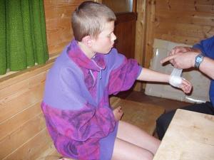 Popáleniny 2. stupně